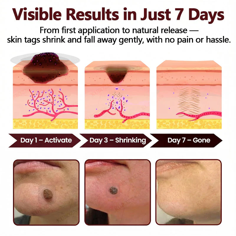 KUBOZN® OryzaDarts TAG’GONE Patch✨Pain-Free Root-Level Removal Powered by Black Rice MicroDarts. - Image 4